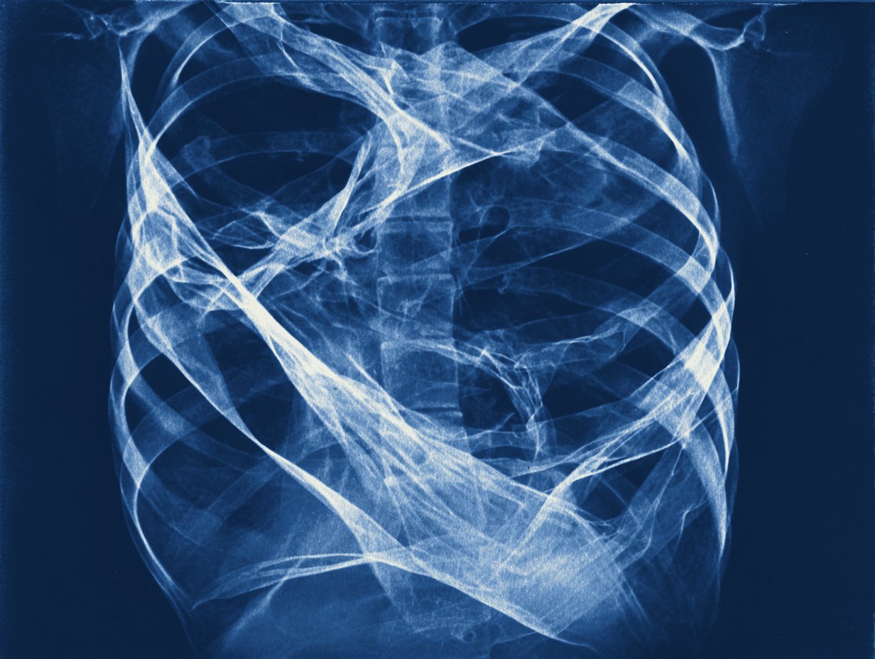 CHIASMA — cyanotype X-ray